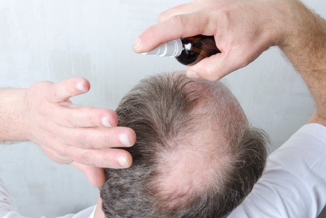 o tratamento de queda capilar pode ser benéfico com minoxidil